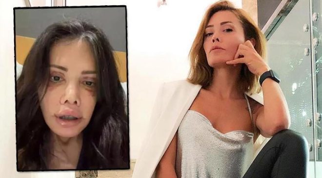 Didem Ceran'dan şoke eden paylaşım: Yüzü nakledilen kişinin alnı kaşıma denk geldi!