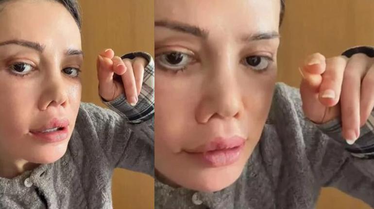Didem Cerandan şoke eden paylaşım: Yüzü nakledilen kişinin alnı kaşıma denk geldi