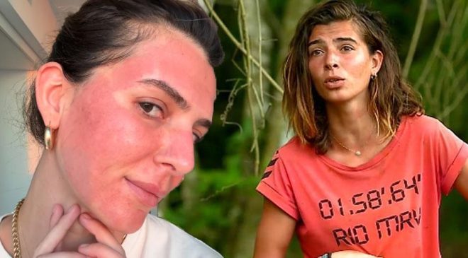 Survivor Merve Aydın’ın değişimi şaşırttı! Yüzüne yaptırdığı işlemi tek tek anlattı
