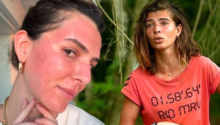 Survivor Merve Aydın’ın değişimi şaşırttı! Yüzüne yaptırdığı işlemi tek tek anlattı