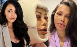 Didem Ceran 15 saatlik operasyonla yüz nakli olmuştu! Kendisini dünyaca ünlü yıldızla karşılaştırdı