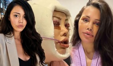 Didem Ceran 15 saatlik operasyonla yüz nakli olmuştu! Kendisini dünyaca ünlü yıldızla karşılaştırdı