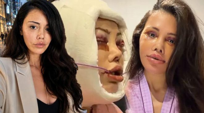 Didem Ceran 15 saatlik operasyonla yüz nakli olmuştu! Kendisini dünyaca ünlü yıldızla karşılaştırdı