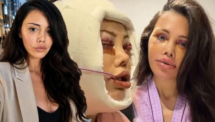 Didem Ceran 15 saatlik operasyonla yüz nakli olmuştu! Kendisini dünyaca ünlü yıldızla karşılaştırdı